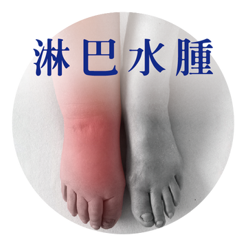 水腫 見證